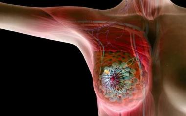 乳腺癌发病率全球和中国都在增加，预防乳腺癌注意啥？